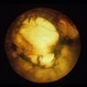 Toxoplasmosis Scar