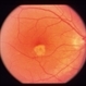 Idiopathic Choroidal Neovasculization (CNV)