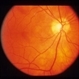Idiopathic Polypoidal Choroidal Vasculopathy