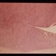 Amelanotic Epibulbar Lesion