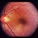 Bilateral Serous Detachments