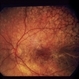 Nummular Depigmented Or Atrophic Pigment Epithelium
