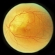 Paracentral Blind Spot And Scotoma