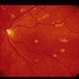 Decreased Visual Acuity (Case 2)
