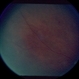 Retinal Vascular Occlusive Disease