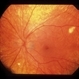 Uveitis