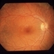 Intraocular Inflammation