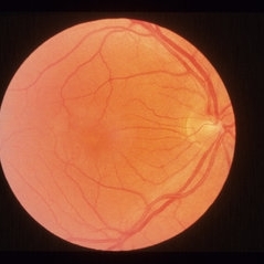 Retinal Vasculitis And Cystoid Macular Edema (CME) - Retina Image Bank