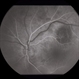 Subretinal Hemorrhage With Exudative Detachment