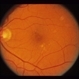 Small Macular Hemorrhage