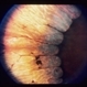Gyrate Atrophy