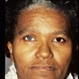 Waardenburg Syndrome