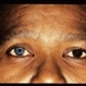 Waardenburg Syndrome