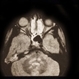 Rhabdomyosarcoma R Orbit