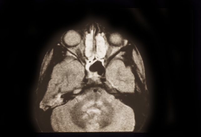 Rhabdomyosarcoma R Orbit - Retina Image Bank