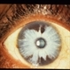 Waardenburg Syndrome
