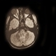 Rhabdomyosarcoma R Orbit