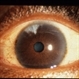 Waardenburg Syndrome