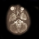 Rhabdomyosarcoma R Orbit
