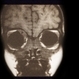 Rhabdomyosarcoma R Orbit