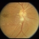 Macular Star in AIDS patient Macular Star in AIDS patient