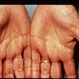 Basal Cell Nevus Syndrome