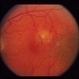 ARMD Laser Rx ARMD Laser Rx