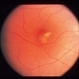 Idiopathic Choroidal Neovasculization (CNV)