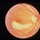 Superior Paracentral Scotoma