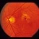 Idiopathic Polypoidal Choroidal Vasculopathy