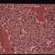 Amelanotic Epibulbar Lesion