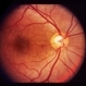 Bilateral Serous Detachments