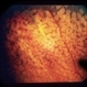 Nummular Depigmented Or Atrophic Pigment Epithelium