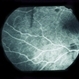 Sub-Arachnoid Hemorrhage
