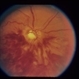 Optic And Hyperemic Disc And Hyperemic Rim