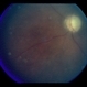 Retinal Vascular Occlusive Disease