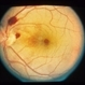 Terson's Syndrome