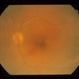 Intraocular Inflammation