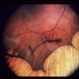 Gyrate Atrophy