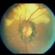 Non-Specific Old Chorioretinetic Scars