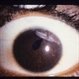 Corneal Laceration Iris In Wound