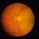 Toxoplasmosis Scar
