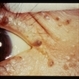 Basal Cell Nevus Syndrome