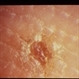 Basal Cell Nevus Syndrome
