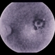 ARMD Laser Rx