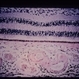 Amyloid histopathology Amyloid histopathology
