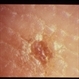 Basal Cell Nevus Syndrome