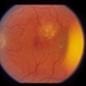 ARMD Laser Rx