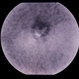 ARMD Laser Rx ARMD Laser Rx