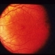 Ocular Albinism Carrier Ocular Albinism Carrier